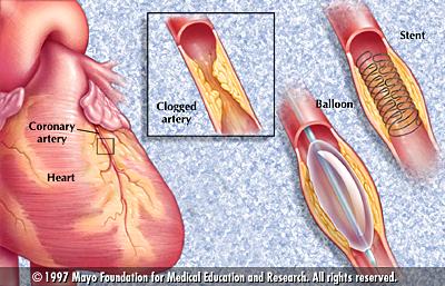 Treating Cardiac Disease